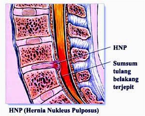 Apa Itu Hnp Dalam Medis